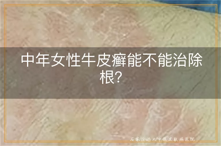 中年女性牛皮癣能不能治除根？