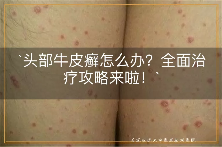 头部牛皮癣怎么办？全面治疗攻略来啦！