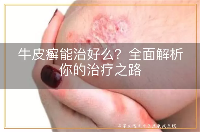 牛皮癣能治好么?全面解析你的治疗之路