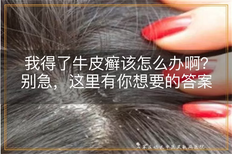 我得了牛皮癣该怎么办啊？别急，这里有你想要的答案！