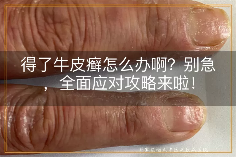 得了牛皮癣怎么办啊？别急，全面应对攻略来啦！