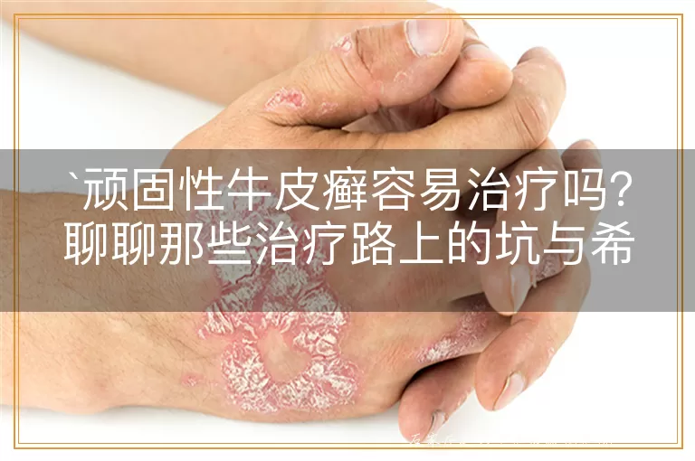 顽固性牛皮癣容易治疗吗？聊聊那些治疗路上的坑与希望