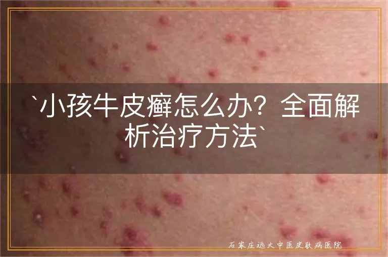 小孩牛皮癣怎么办？全面解析治疗方法