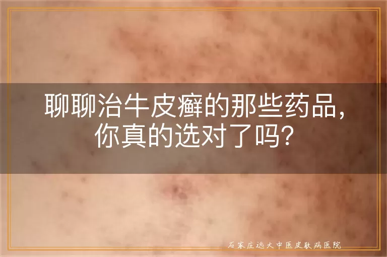 聊聊治牛皮癣的那些药品，你真的选对了吗？