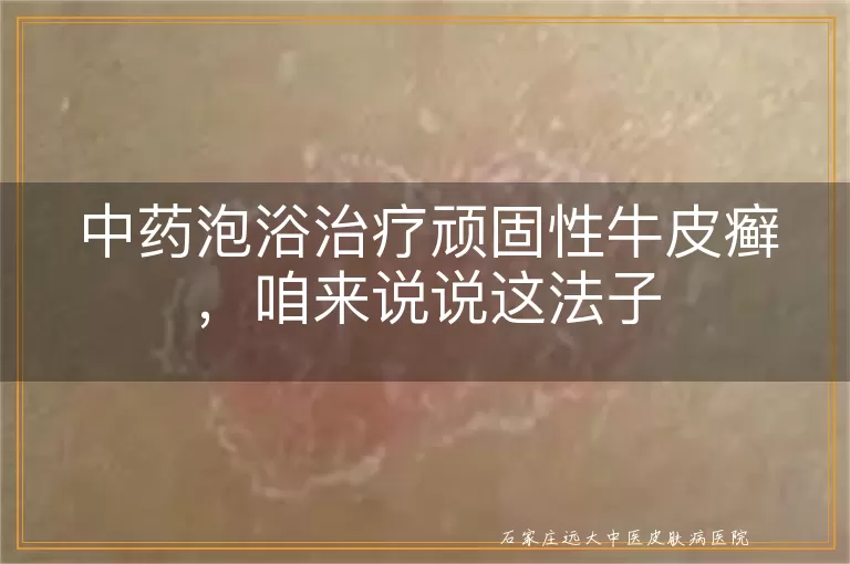 中药泡浴治疗顽固性牛皮癣，咱来说说这法子