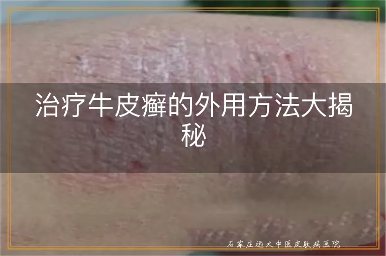 治疗牛皮癣的外用方法大揭秘