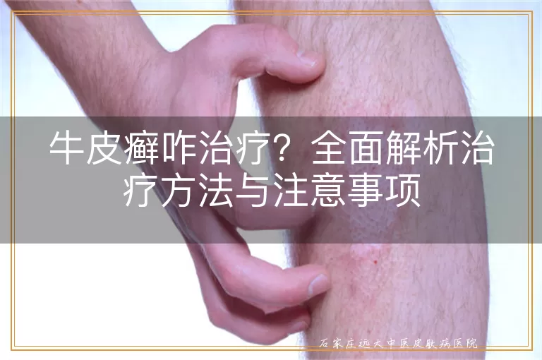 牛皮癣咋治疗？全面解析治疗方法与注意事项