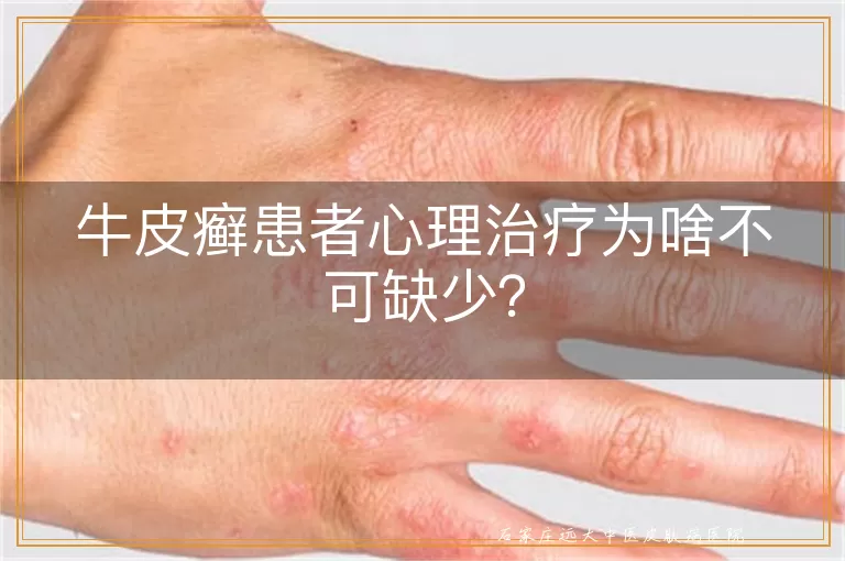 牛皮癣患者心理治疗为啥不可缺少？