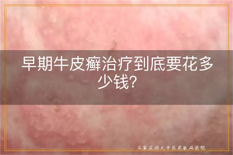 早期牛皮癣治疗到底要花多少钱？