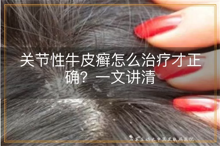 关节性牛皮癣怎么治疗才正确？一文讲清