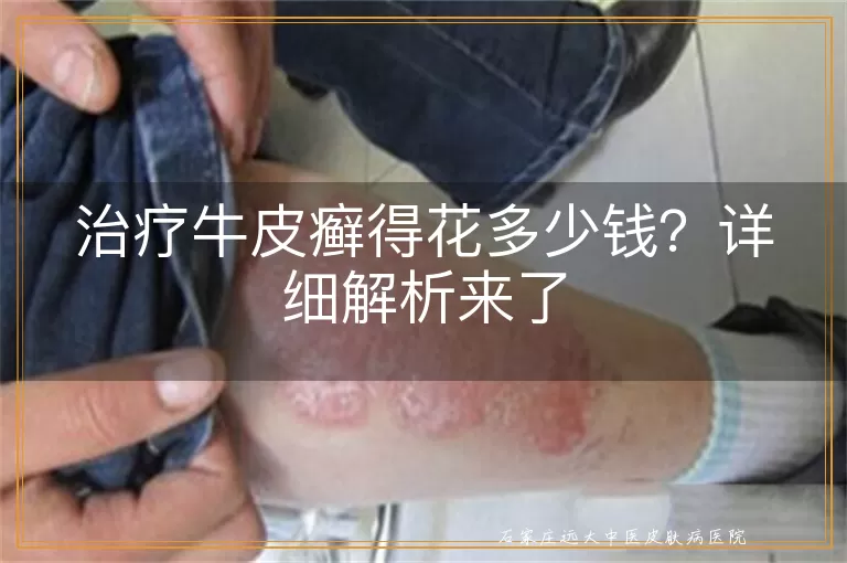 治疗牛皮癣得花多少钱？详细解析来了
