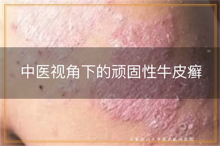 中医视角下的顽固性牛皮癣