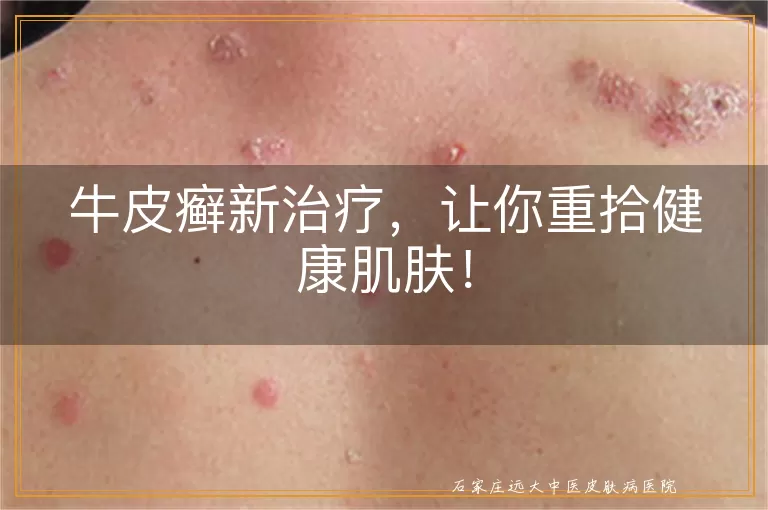牛皮癣新治疗，让你重拾健康肌肤！