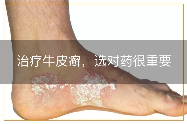 治疗牛皮癣，选对药很重要