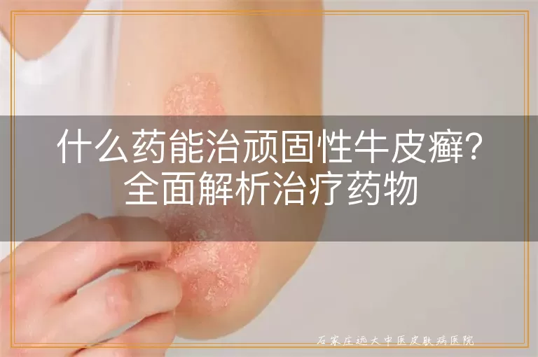 什么药能治顽固性牛皮癣？全面解析治疗药物