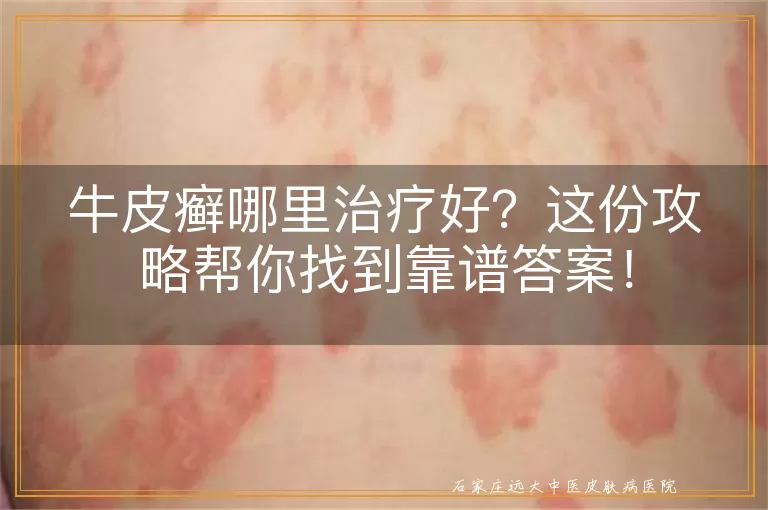 牛皮癣哪里治疗好？这份攻略帮你找到靠谱答案！