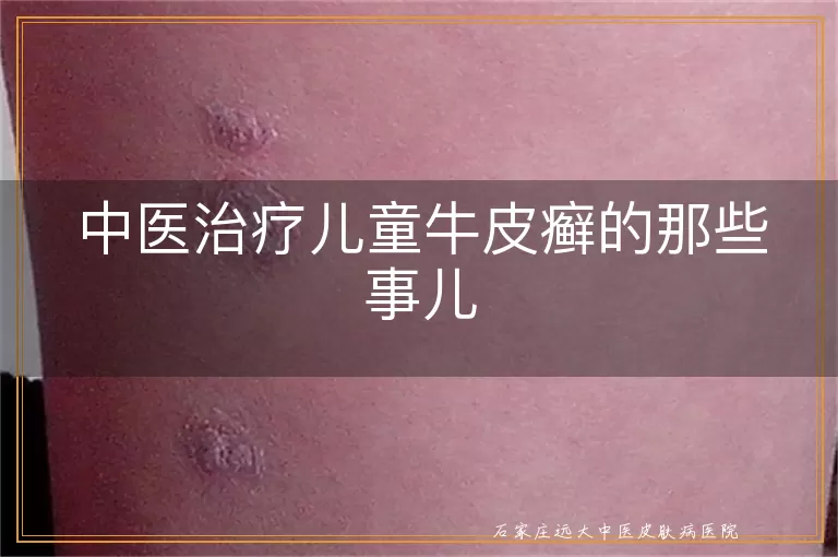 中医治疗儿童牛皮癣的那些事儿
