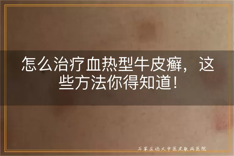 怎么治疗血热型牛皮癣，这些方法你得知道！