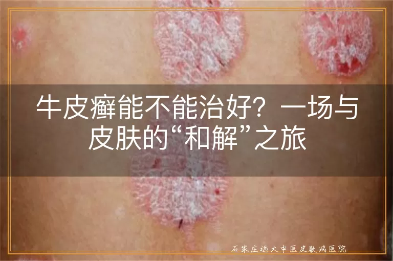 牛皮癣能不能治好？一场与皮肤的“和解”之旅