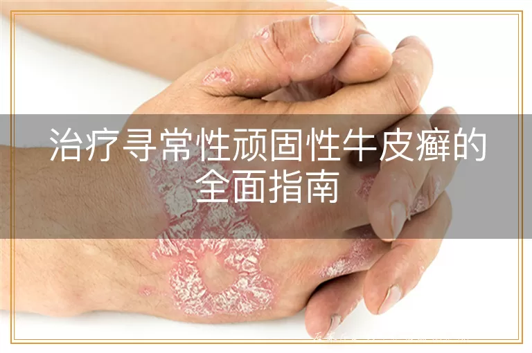 治疗寻常性顽固性牛皮癣的全面指南