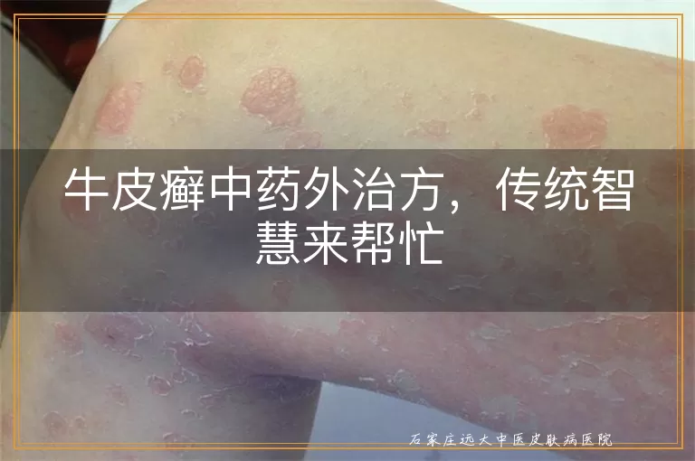 牛皮癣中药外治方，传统智慧来帮忙