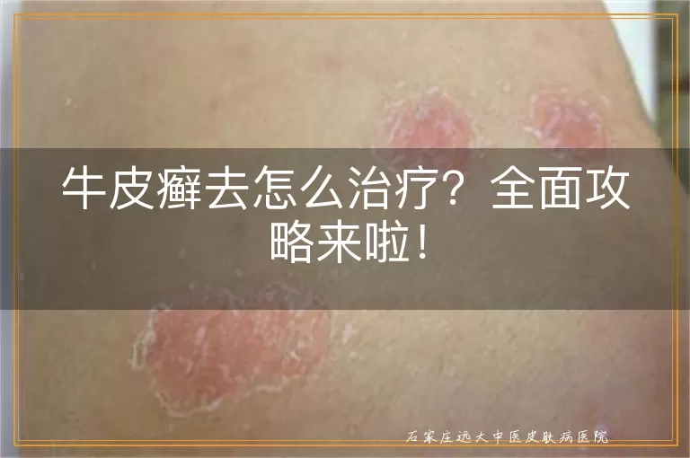 牛皮癣去怎么治疗？全面攻略来啦！