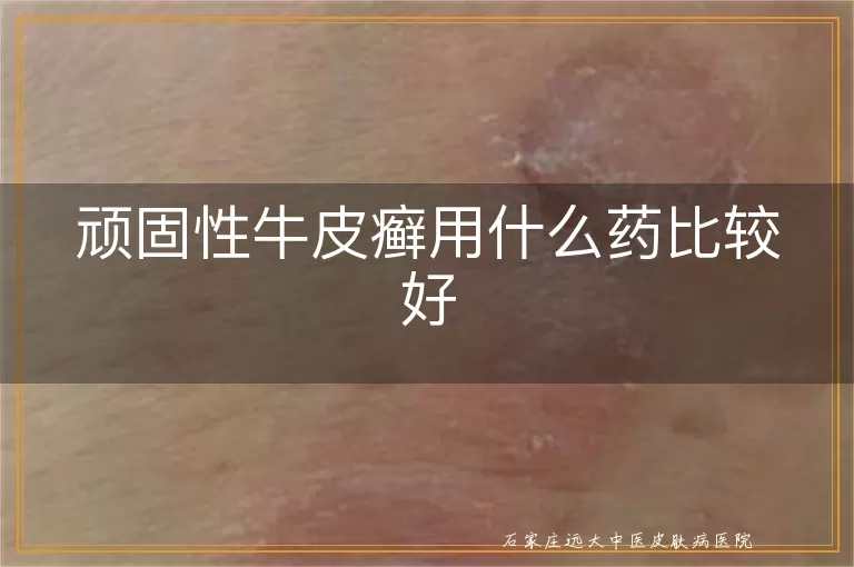 顽固性牛皮癣用什么药比较好