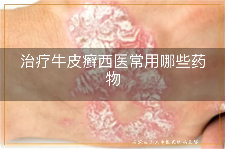 治疗牛皮癣西医常用哪些药物