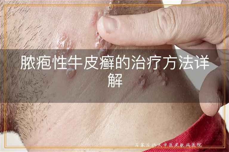 脓疱性牛皮癣的治疗方法详解