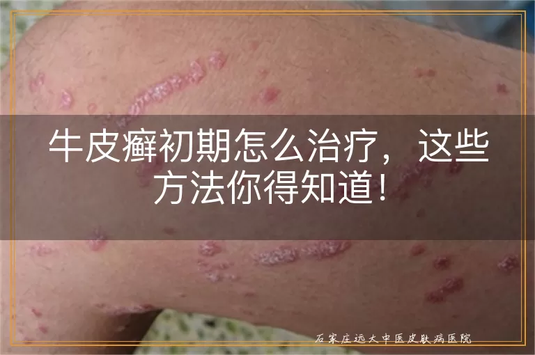 牛皮癣初期怎么治疗，这些方法你得知道！