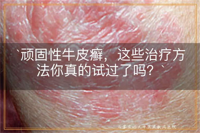 顽固性牛皮癣，这些治疗方法你真的试过了吗？