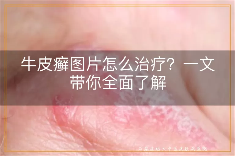 牛皮癣图片怎么治疗？一文带你全面了解