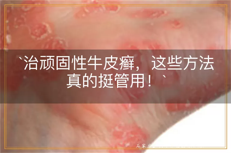 治顽固性牛皮癣，这些方法真的挺管用！