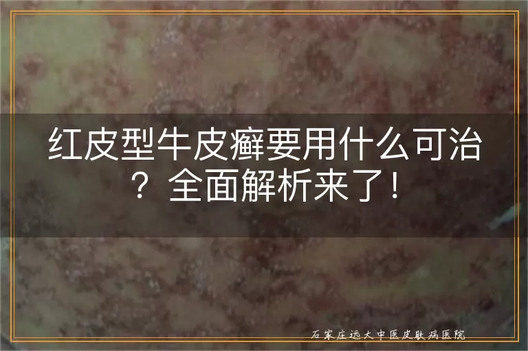 红皮型牛皮癣要用什么可治？全面解析来了！