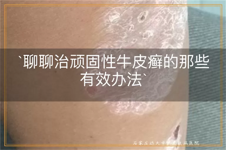 聊聊治顽固性牛皮癣的那些有效办法