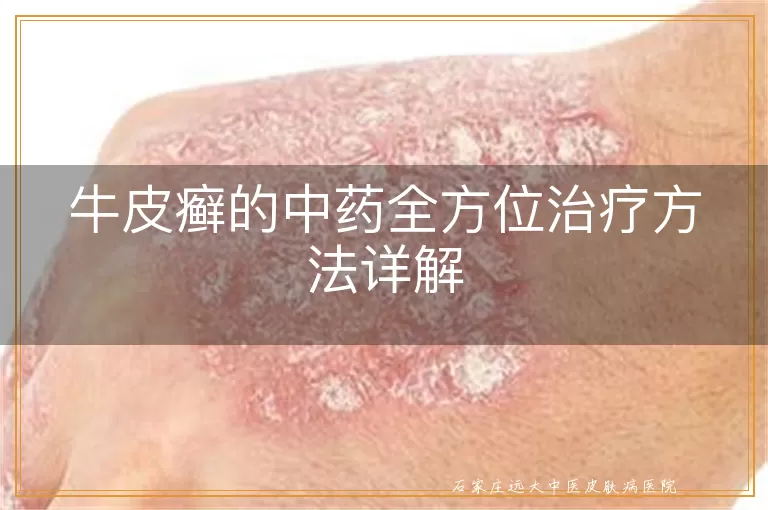 牛皮癣的中药全方位治疗方法详解