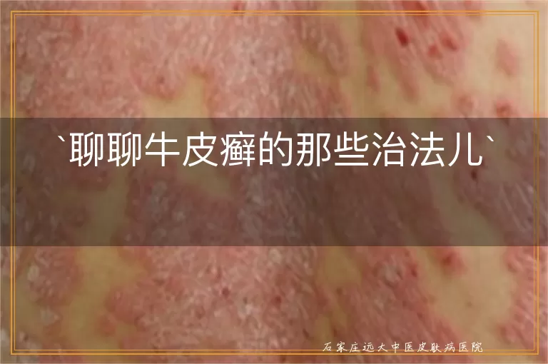 聊聊牛皮癣的那些治法儿