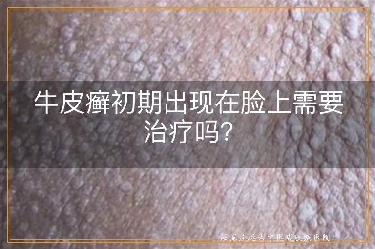 牛皮癣初期出现在脸上需要治疗吗？