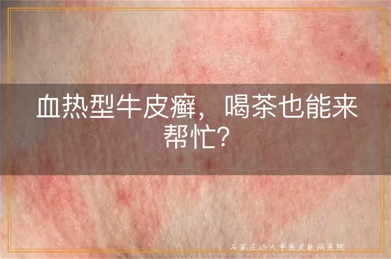 血热型牛皮癣，喝茶也能来帮忙？