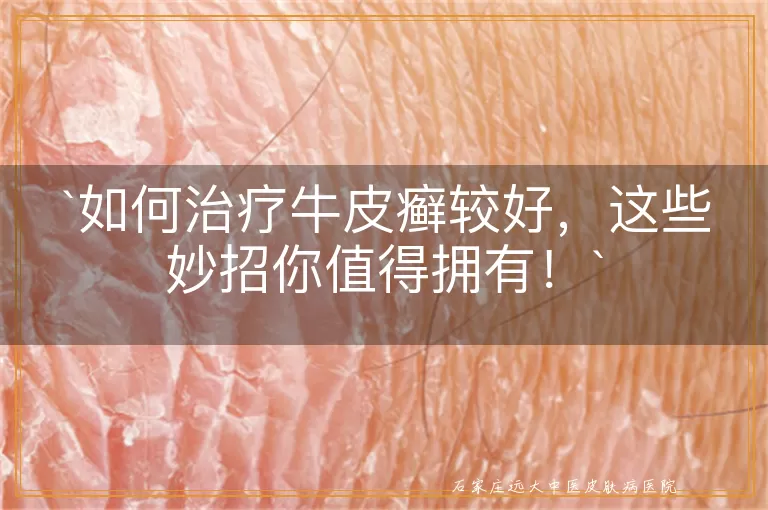 如何治疗牛皮癣较好，这些妙招你值得拥有！