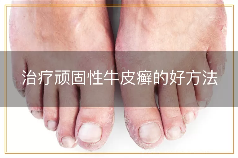 治疗顽固性牛皮癣的好方法