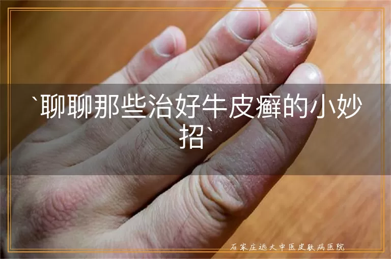 聊聊那些治好牛皮癣的小妙招