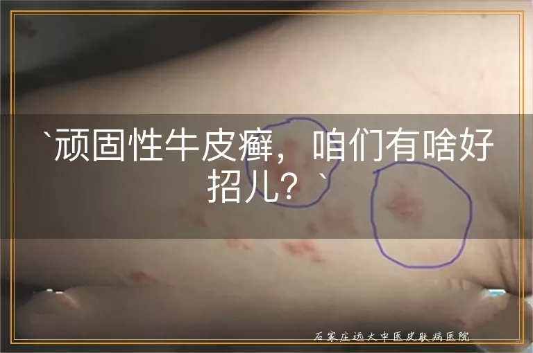顽固性牛皮癣，咱们有啥好招儿？