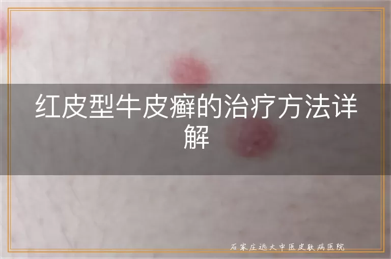红皮型牛皮癣的治疗方法详解