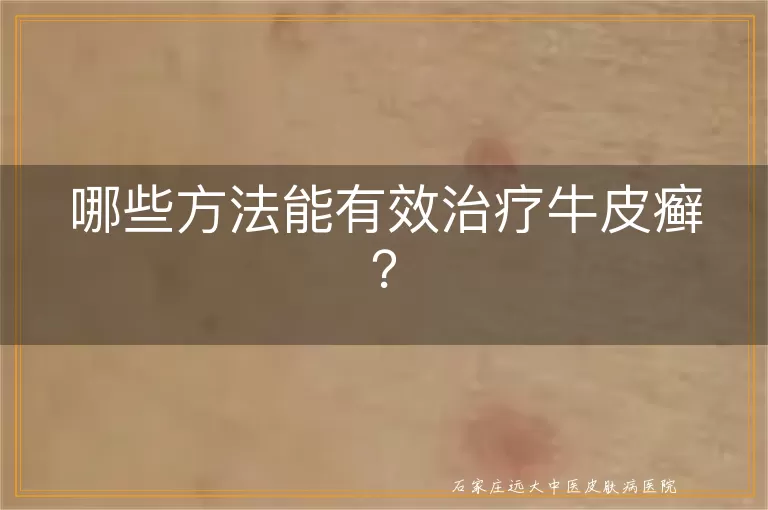 哪些方法能有效治疗牛皮癣？
