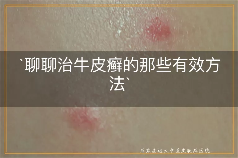 聊聊治牛皮癣的那些有效方法