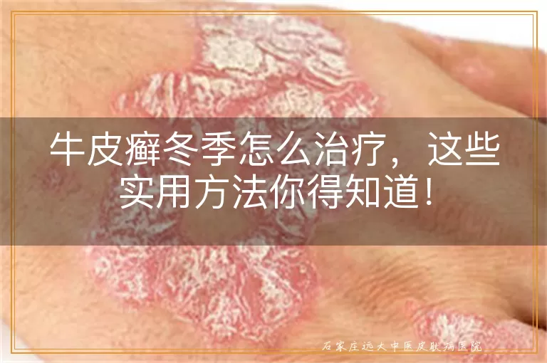 牛皮癣冬季怎么治疗，这些实用方法你得知道！