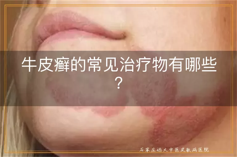 牛皮癣的常见治疗物有哪些?