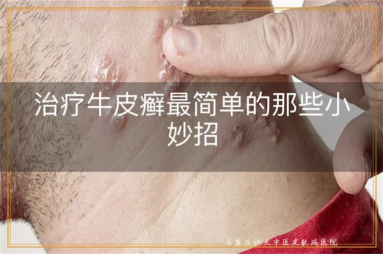 治疗牛皮癣最简单的那些小妙招