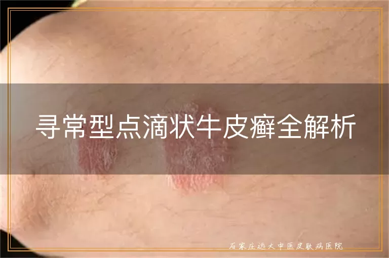 寻常型点滴状牛皮癣全解析